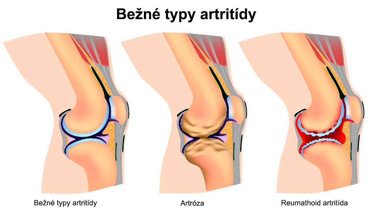 Bežné typy artritídy a artrózy.